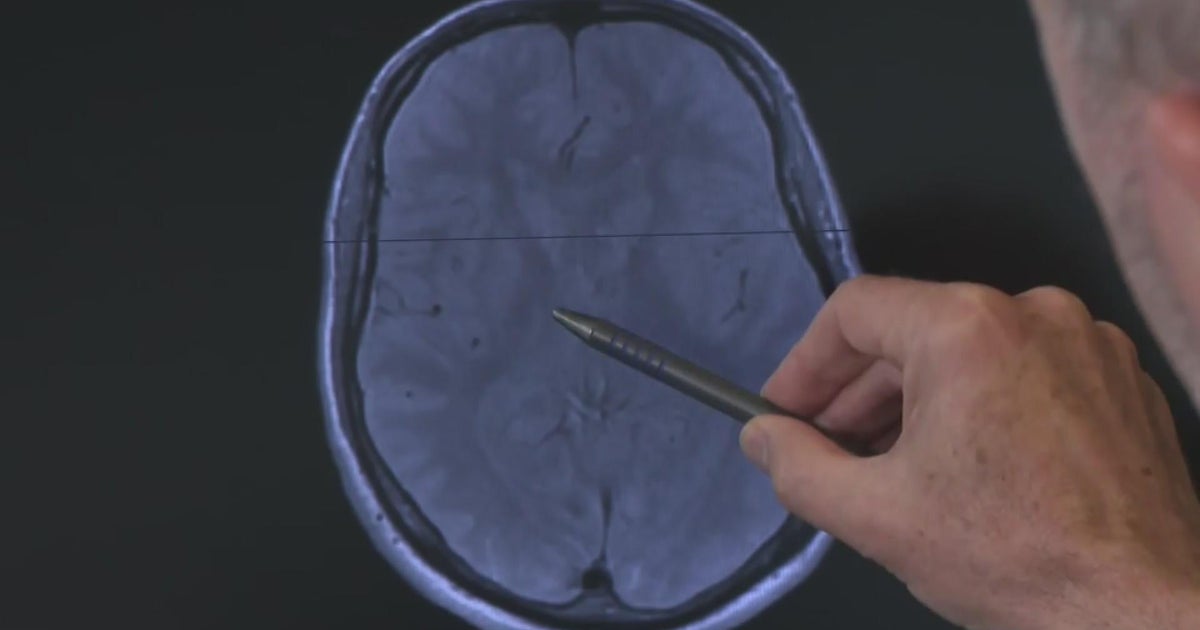 Important stroke warning signs cbs minnesota