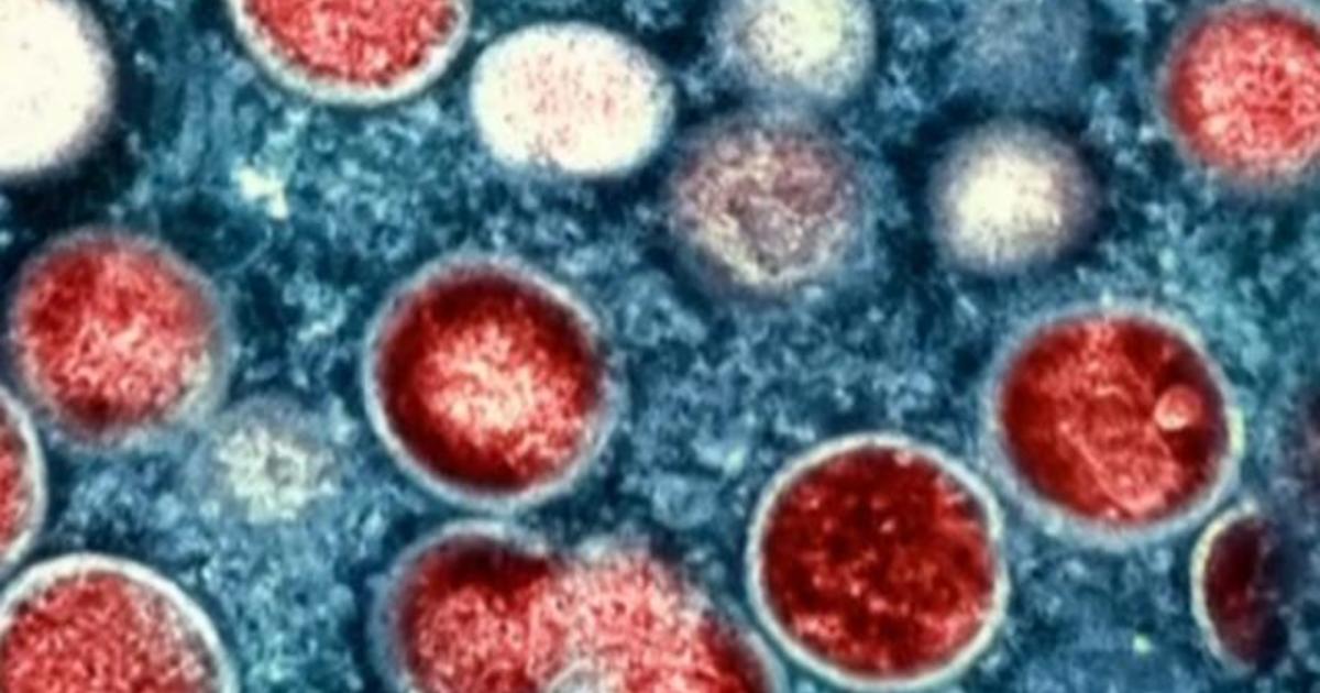 More than a dozen new mpox cases under investigation in the Chicago area