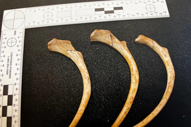 Mengqi Ji's broken ribs 