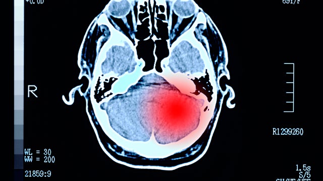 Brain damage tumour headache 