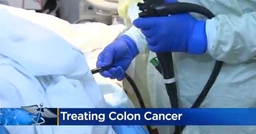 Doctors have new treating colon cancer CBS Colorado