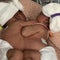 Conjoined twins separated by Texas doctors after historic 11-hour surgery