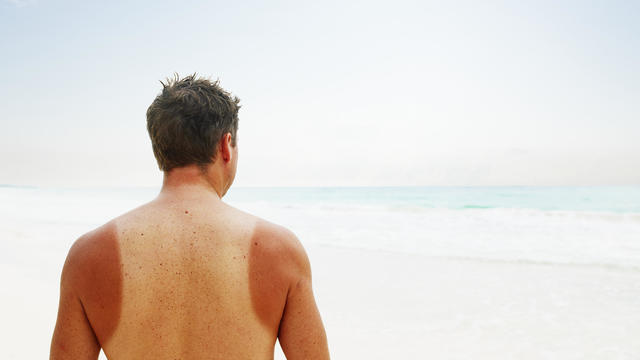 Man with sun burn standing near water on beach 