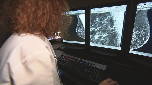 mammogram, cancer 
