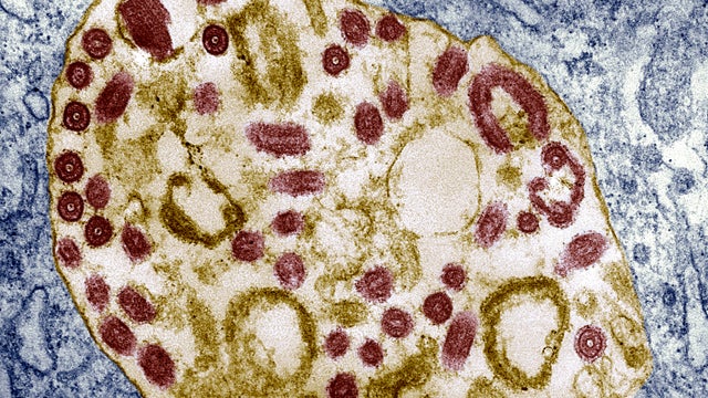 Marburg virus kills 11 in Rwanda. What to know about the Ebola-like outbreak and symptoms