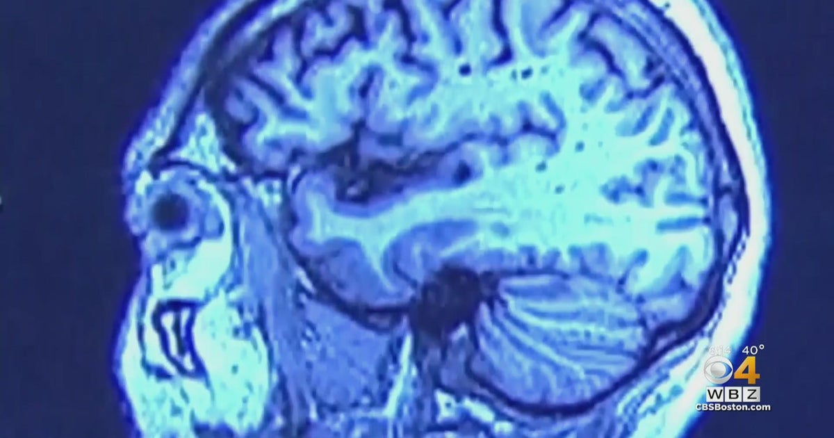 NFL player-led study sheds light on long-term impact of concussions ...