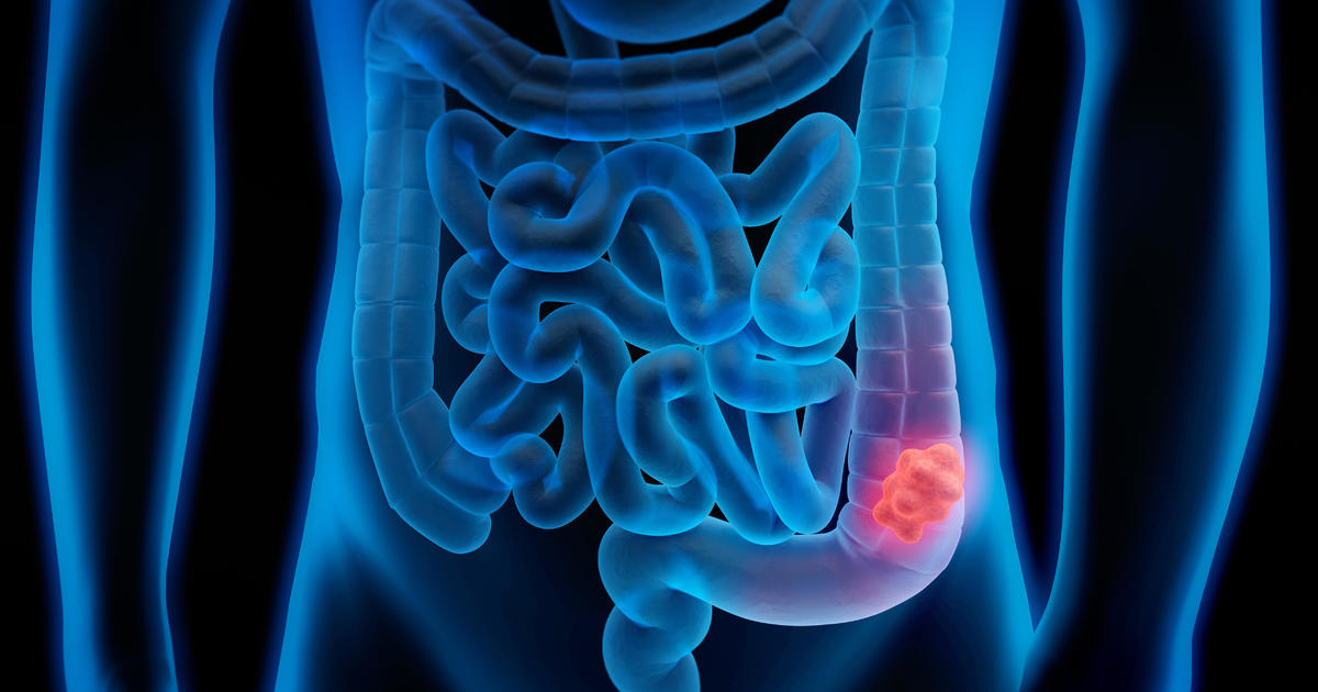 Colon cancer cases rising in younger patients