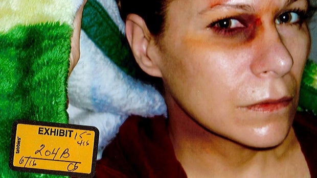 Stephanie Fernandes black eye