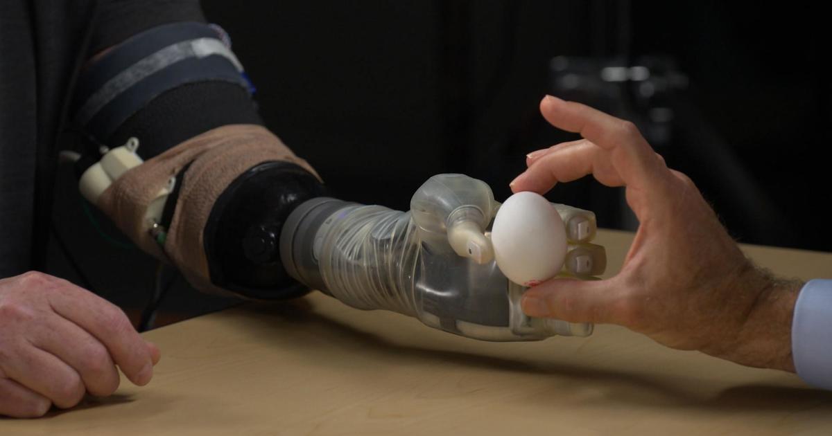 Advancements in prosthetics limb technology allow feeling, control |  60 Minutes
