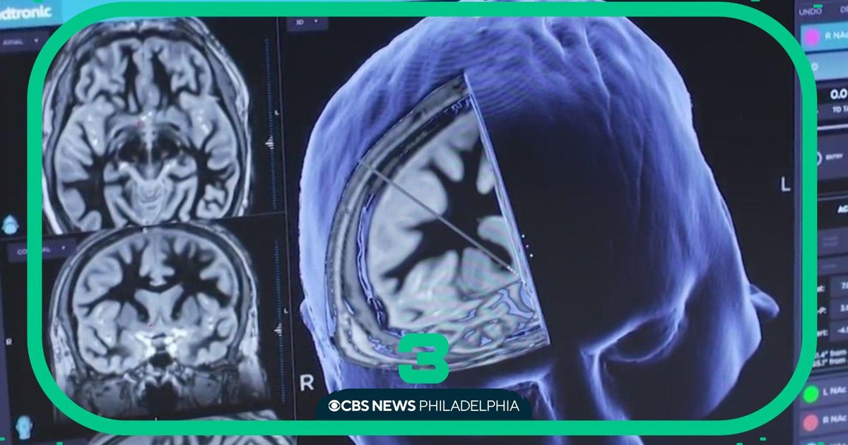 New lab tests change the way Parkinson's Disease is diagnosed CBS Philadelphia