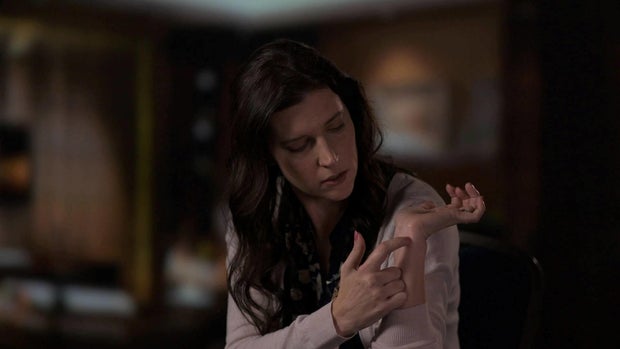 Alisa Mathewson showing wrist scar