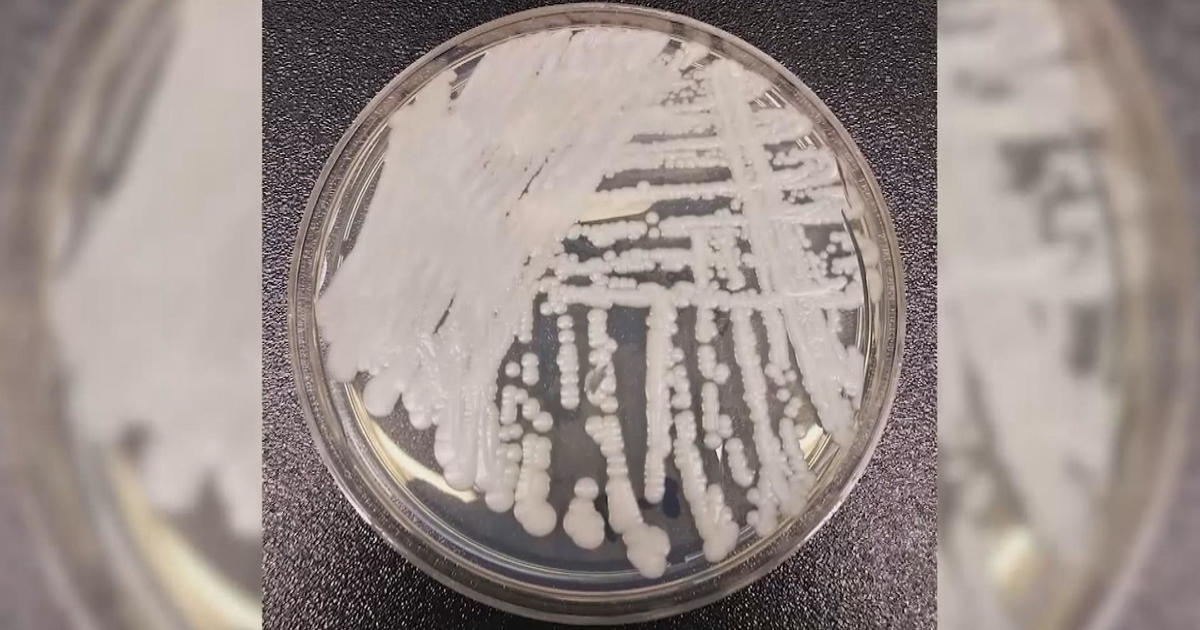 Health officials warn of deadly fungus in New Jersey