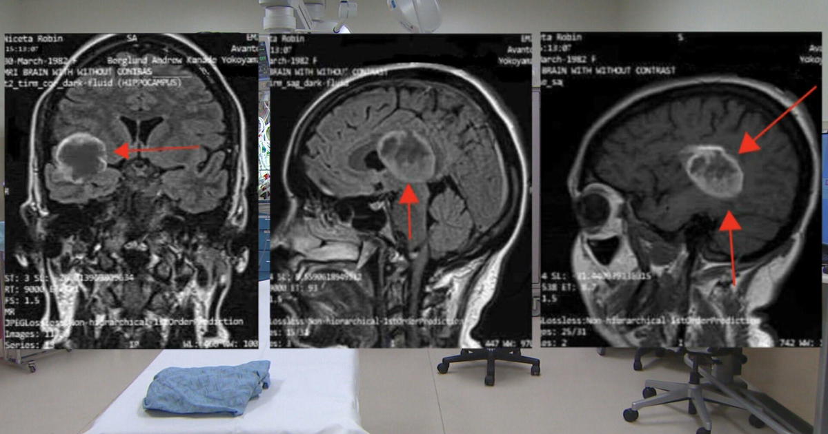 brain scan with tumor