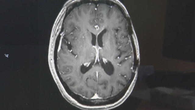 16pkg-ss-brain-cancer-treatment-transfer-frame-187.jpg 