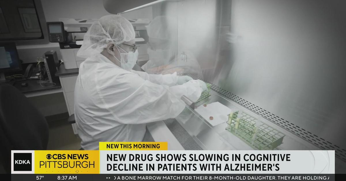 Investors impatient for Alzheimer's cure - MarketWatch