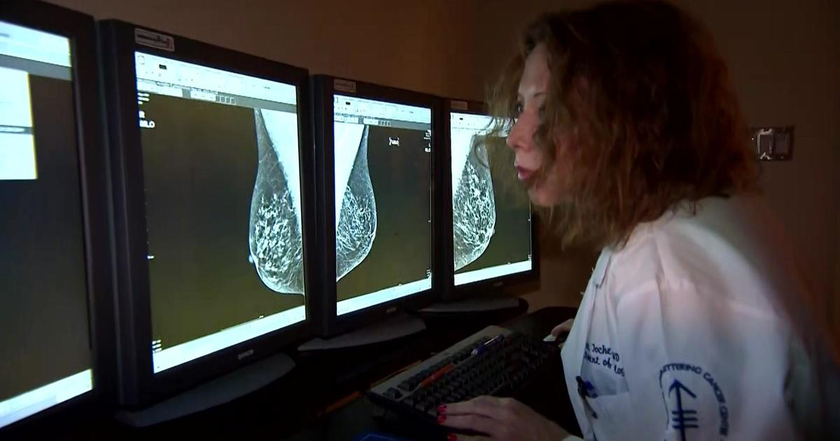 Experts Lower Recommended Age For Mammograms From 50 To 40 Cbs New York