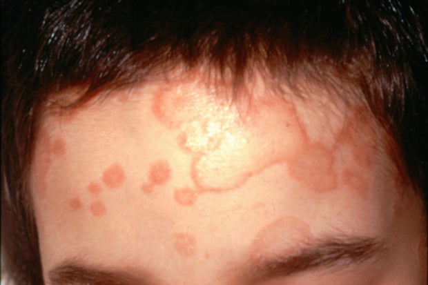 Ringworm infection appears as a reddish rash on a person's forehead