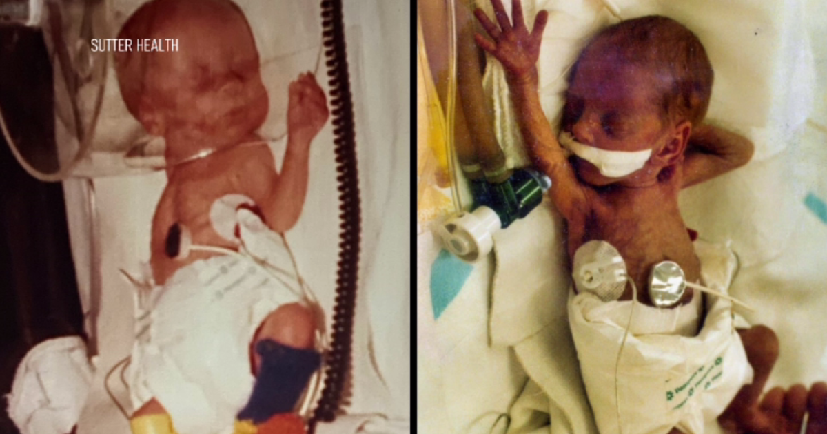 Micro-premies born 40 years ago reunite with medical team that delivered them in Sacramento
