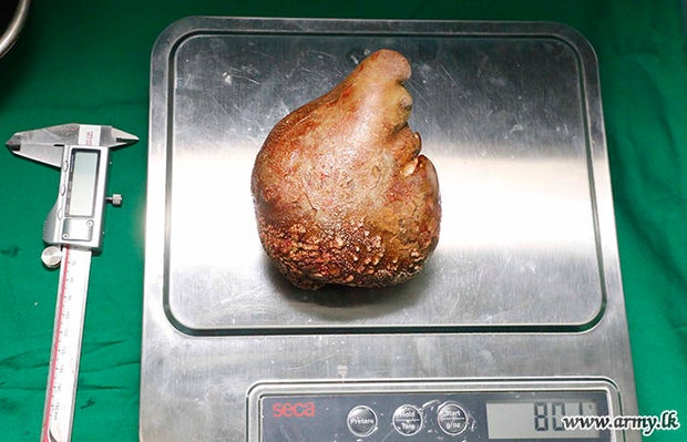Doctors remove world's largest kidney stone from retired soldier in Sri Lanka