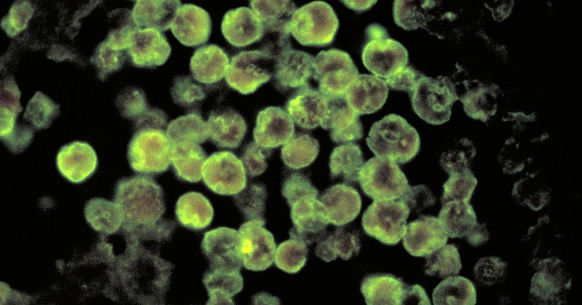 Swimmer in Texas dies after infection caused by brain-eating amoeba