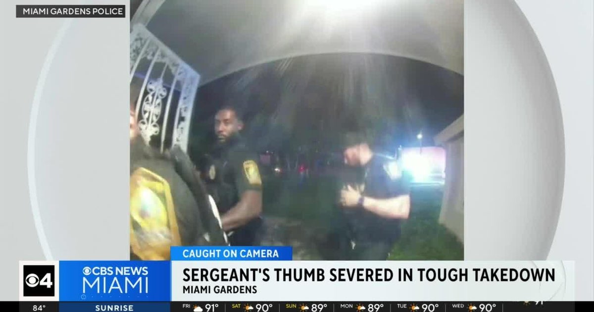 Miami Gardens police sergeant suffers severed thumb in the course of arrest