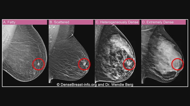 dense-breast-tissue-on-a-mammogram.jpg 