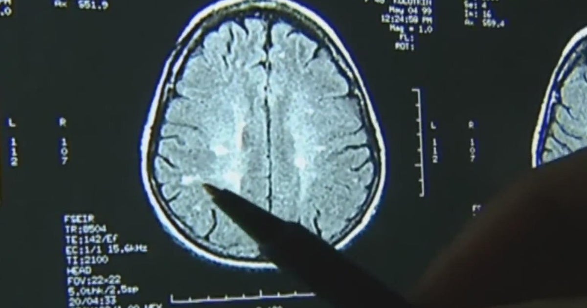 UC Davis study suggests differences in how men, women respond to stress
