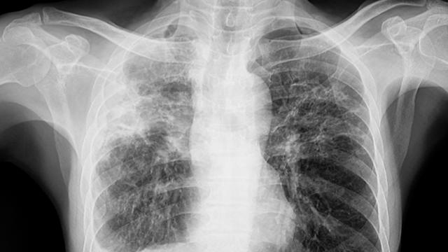Chest x ray of the patient with lungs tuberculosis 