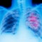 Lung cancer mystery: Why are healthy, non-smoking, Asian women contracting the disease?