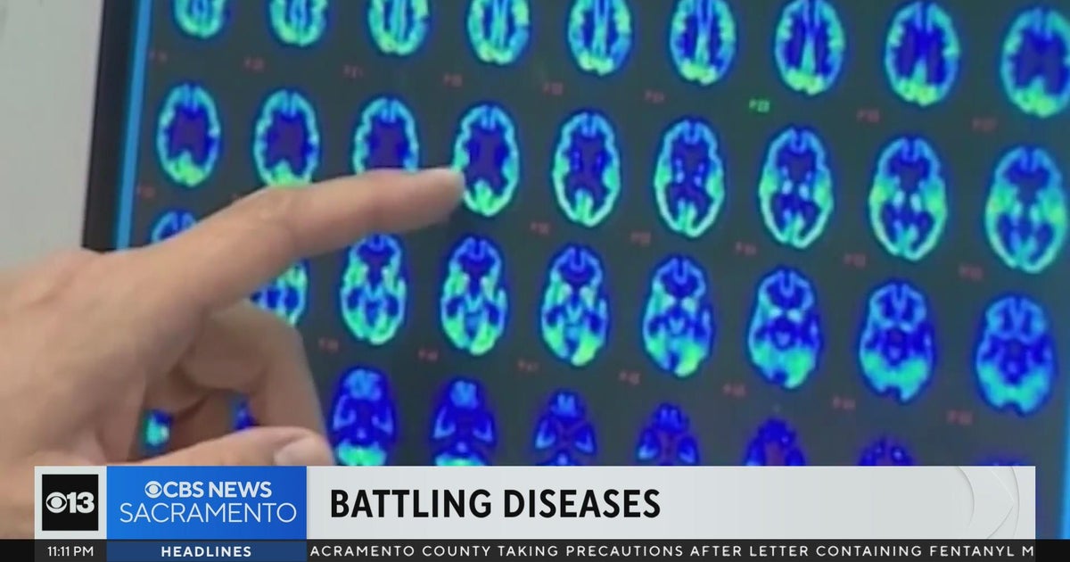 Researchers find increasing links between dementia and diabetes