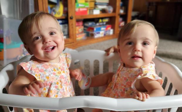 twins peyton and madison rare heart condition surgery childrens minnesota 