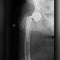 Titanium hip implants snapped in hundreds of people, took years before some products recalled