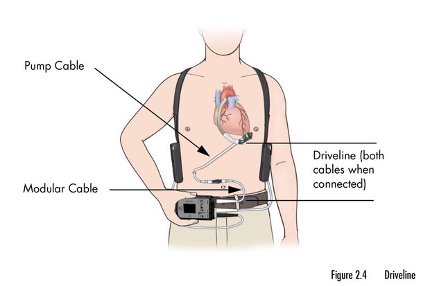 HeartMate 3 diagram