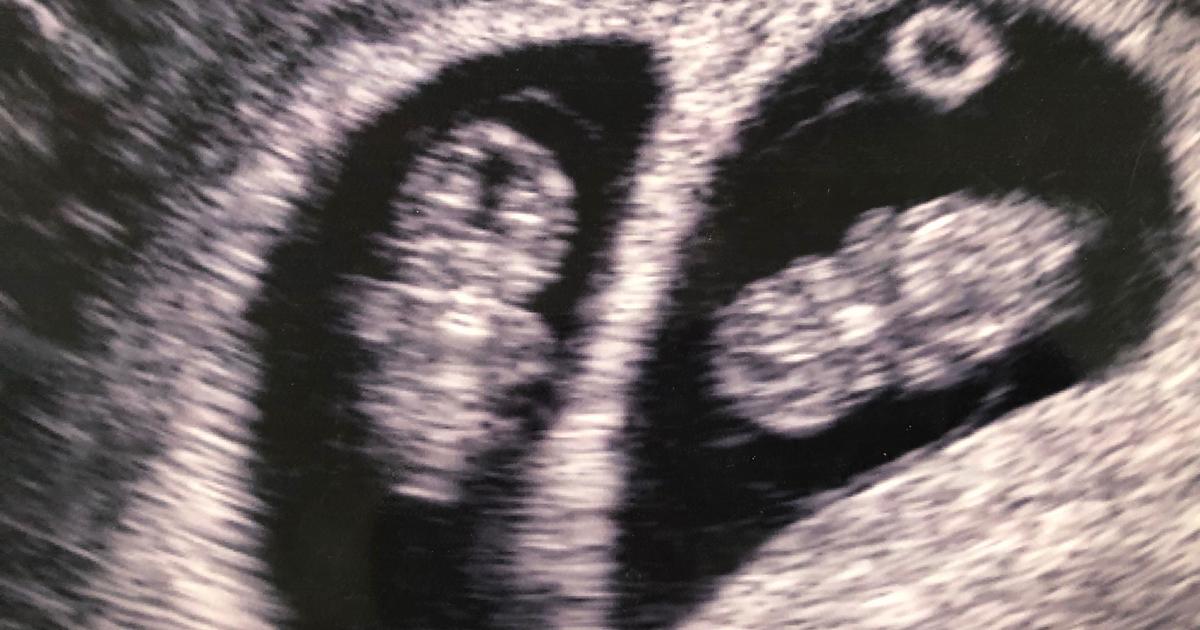 Жена от Алабама с рядка двойна матка ражда момичета близначки — в 2 различни дни