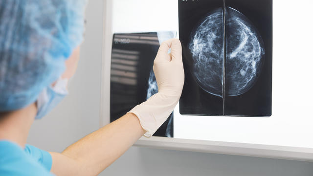Doctor reading a mammogram image 