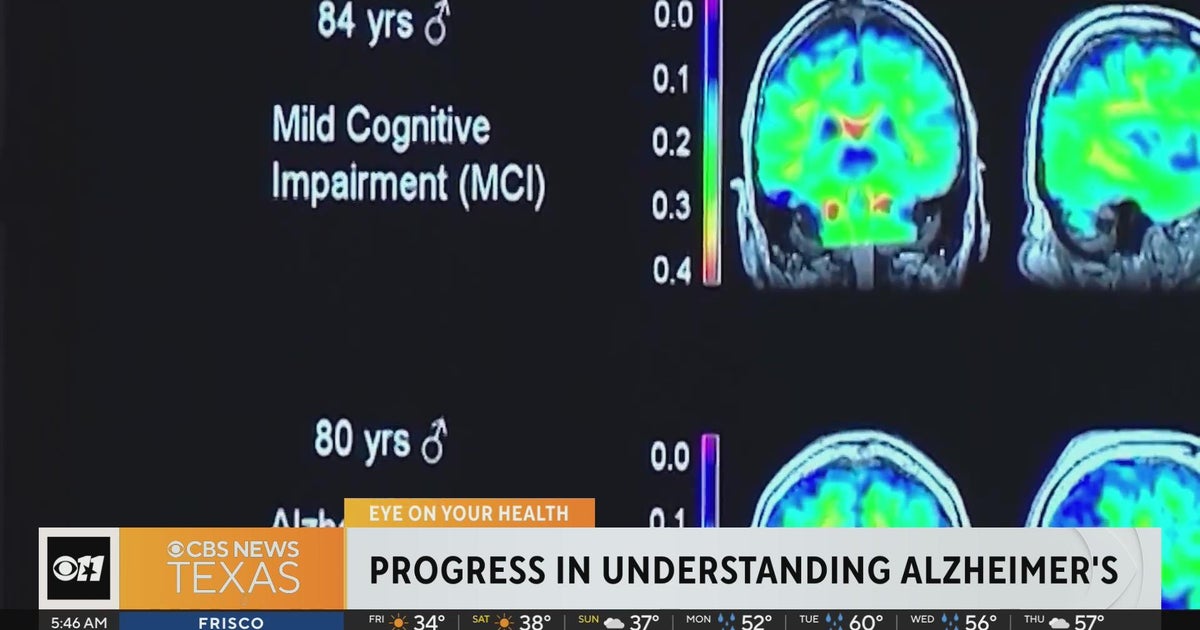 Doctors say they're one step closer to understanding Alzheimer's - CBS ...