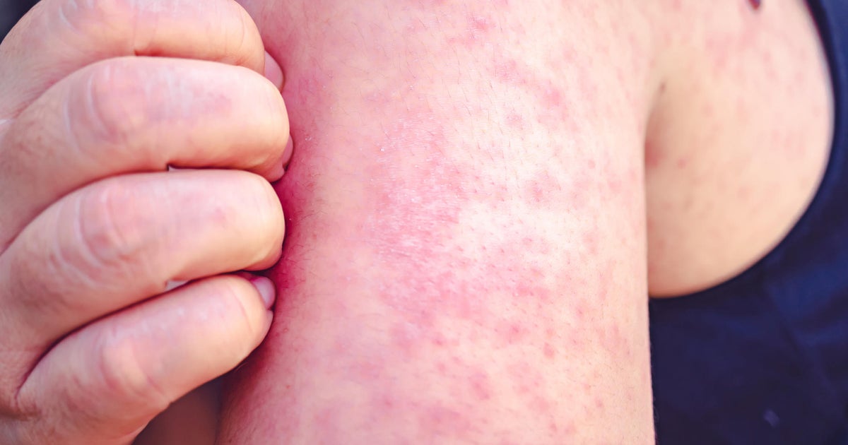 Broward has 9th verified case of measles Broward has 9th verified case of measles
