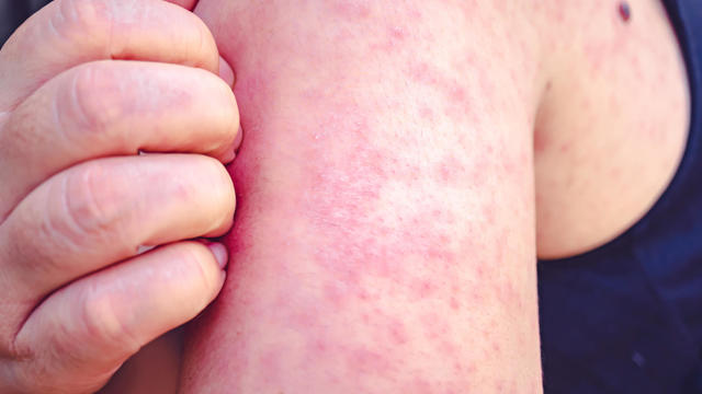 Measles, Women scratch the upper arm with one hand due to the numerous red pruritus., Measles is a disease that can spread easily. 