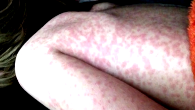 measles.png 