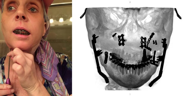 Photos of Lisa Schmidt and a medical scan of her jaw showing hardware implants