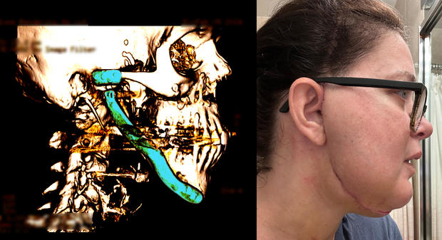A medical scan of Lisa Schmidt's jaw and a photo of her scar after surgery 