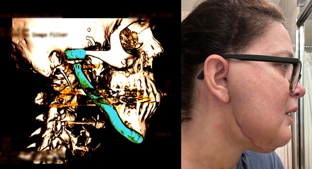 A medical scan of Lisa Schmidt's jaw and a photo of her scar after surgery