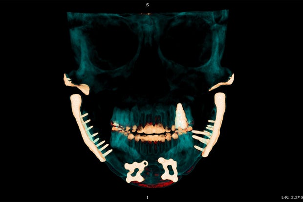 A medical scan of Lisa Schmidt's jaw