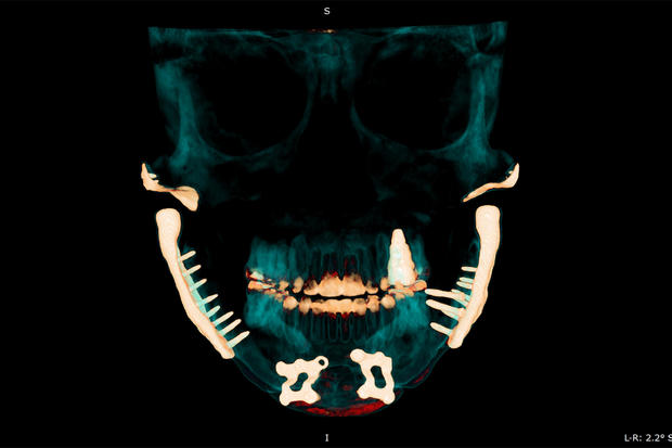 A medical scan of Lisa Schmidt's jaw 