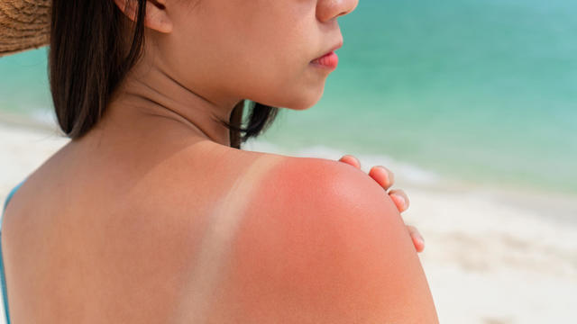 Sunburned skin on shoulder of a woman because of not using cream with sunscreen protection. Red skin sun burn after Sunbathing at the beach. Summer and holiday concept 