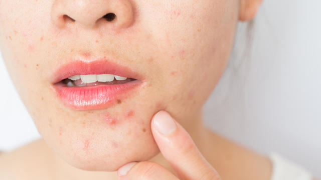 Closeup of woman half face with problems of acne inflammation (Papule and Pustule) on her face. 
