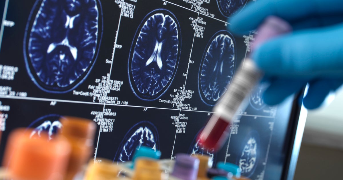 Family's genes offer new clue to delaying Alzheimer's disease