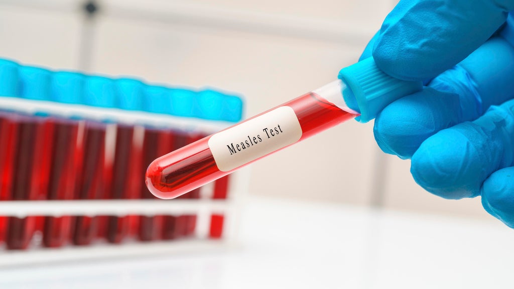 2 children diagnosed with measles in Yolo County, marking first cases since 2015