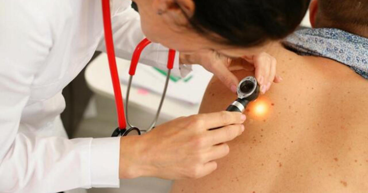 Dermatologists battle online "anti-sunscreen movement" spreading misinformation, health risks
