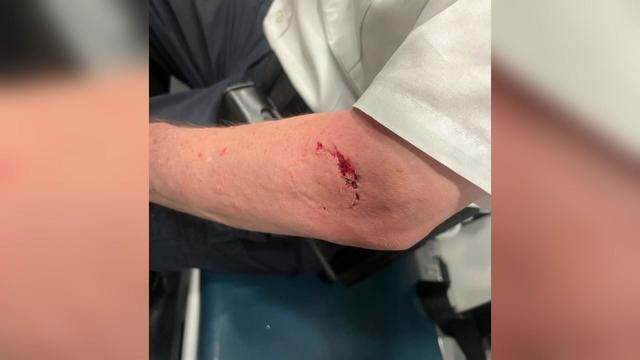 What appears to be a bite mark on a man's arm. 